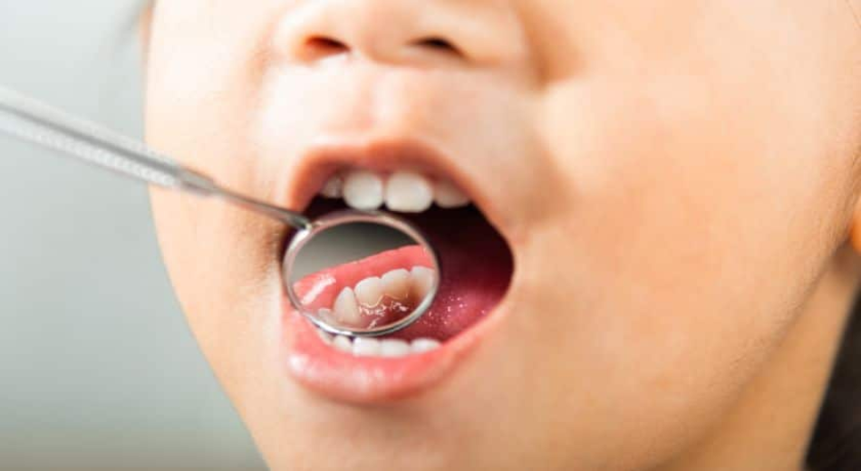Cavities