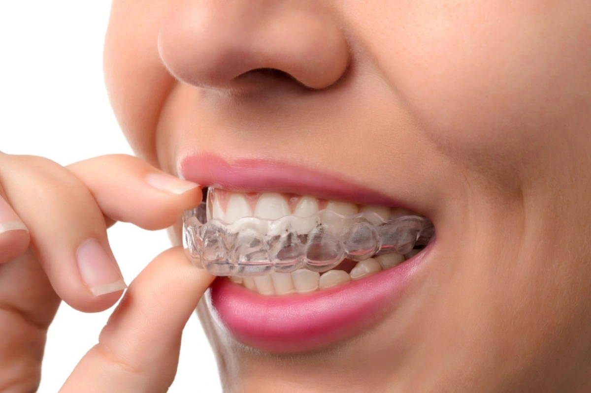 Clear aligners