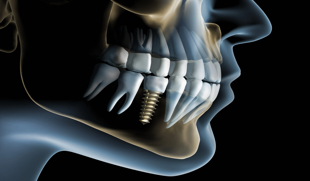 Dental Implants