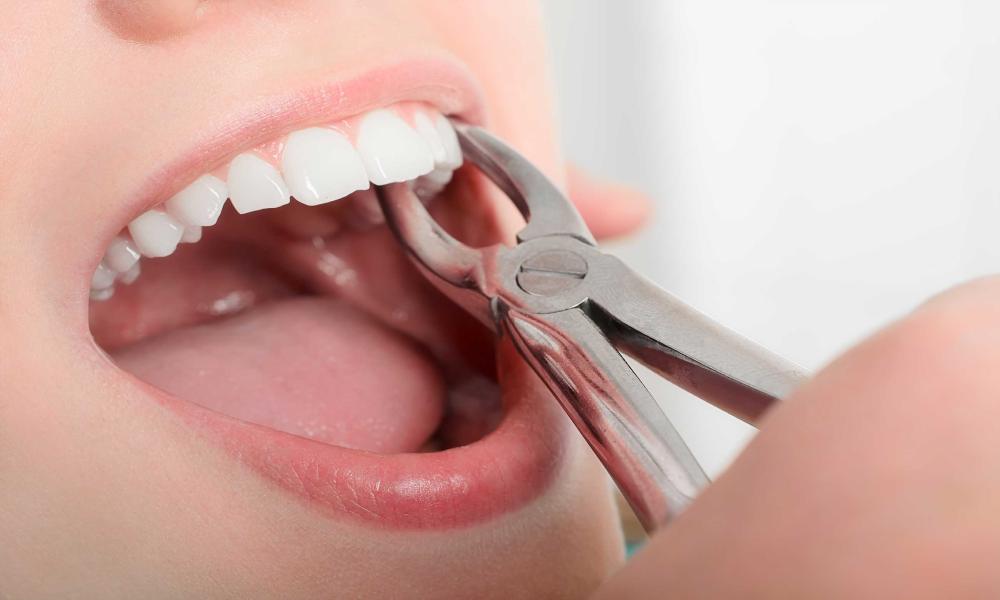 Extracting Tooth