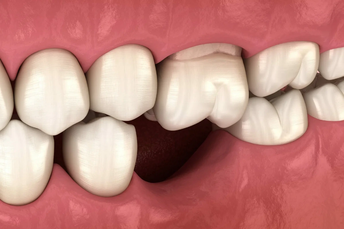Missing tooth