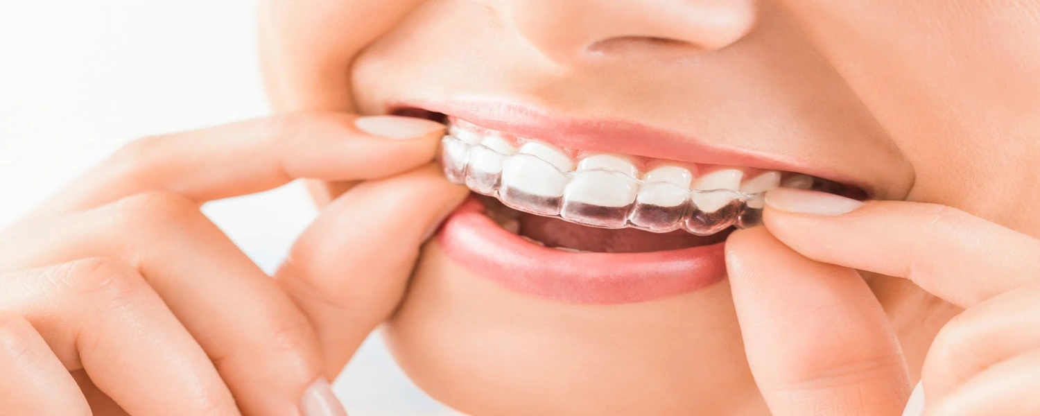 clear aligner for teeths