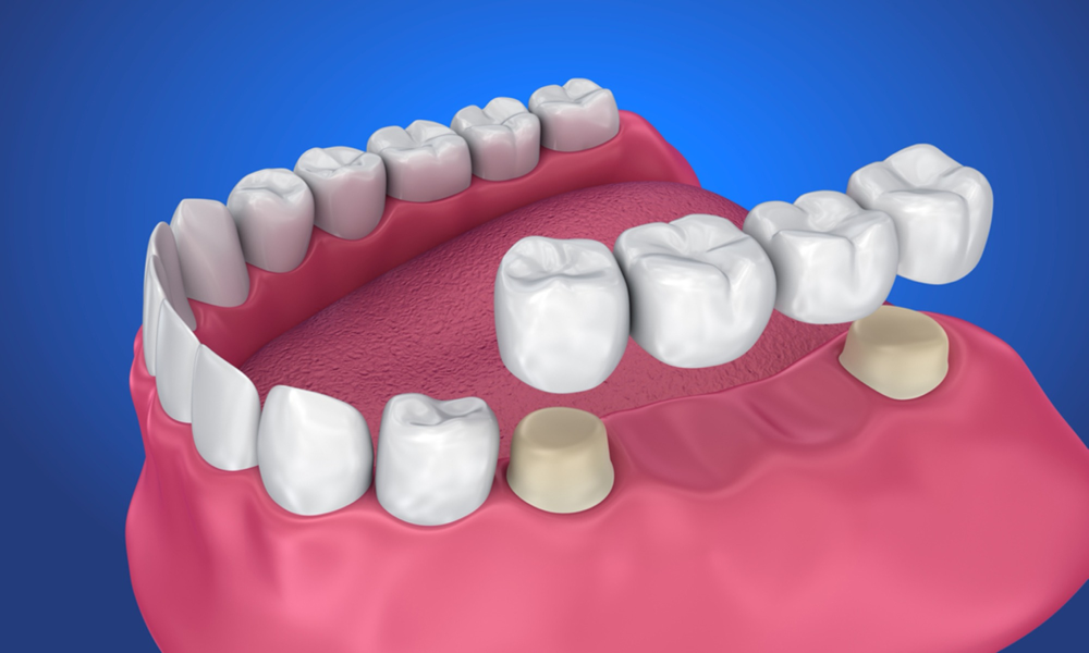 Dental Bridges guide