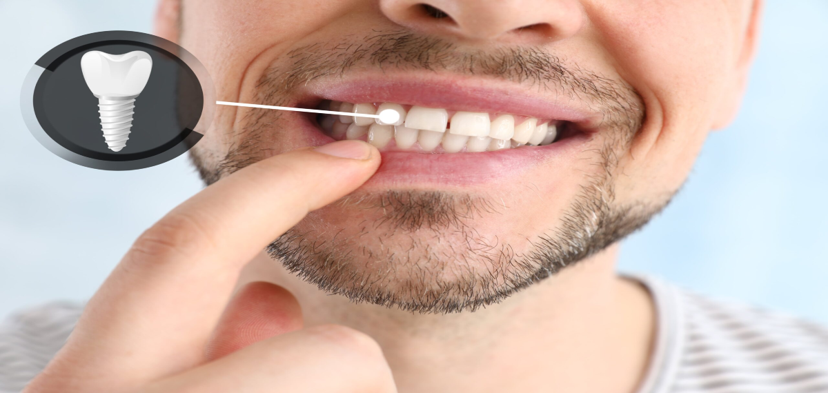 dental implant recovery