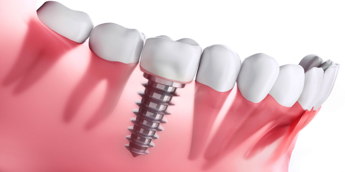 teeth implantation