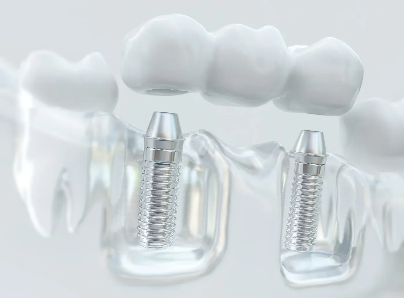 3D illustration of a dental implant