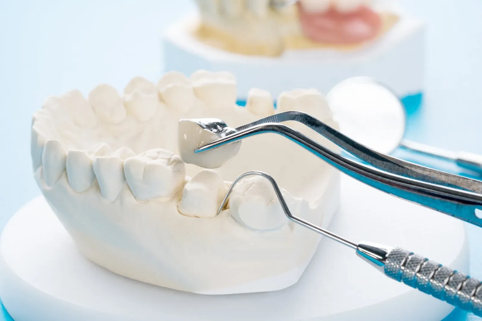 Dental jaw model showing prosthetic crowns