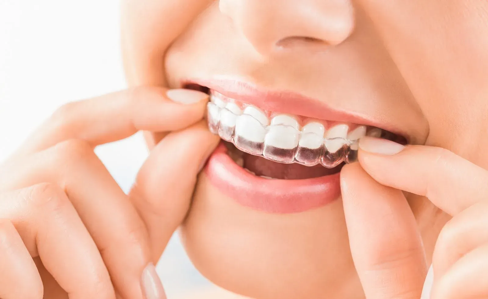 Patient applying clear Invisalign aligners