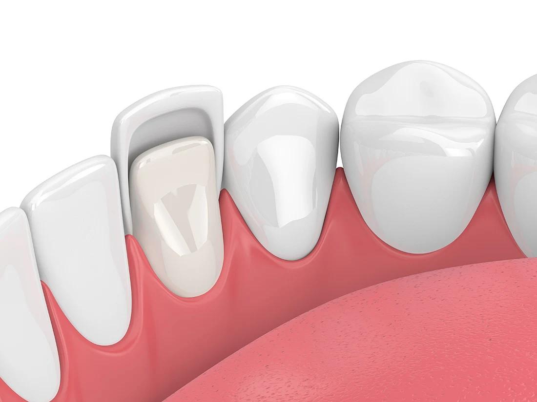 3D illustration of a dental veneer being placed on a front tooth