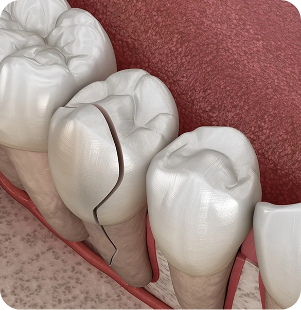 Illustration of teeth with a visible crack in a molar