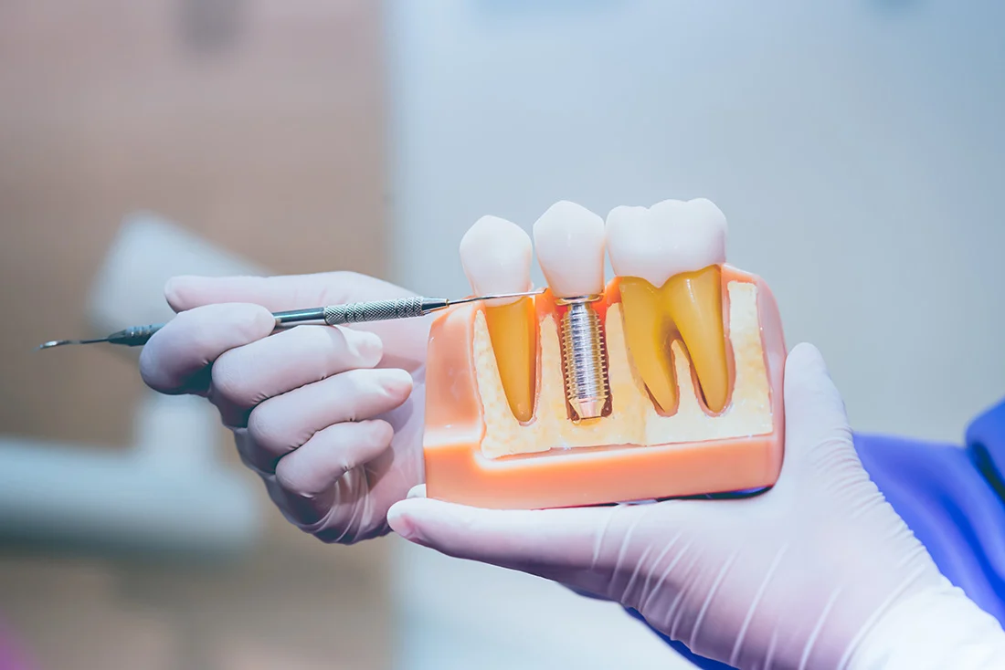 Dentist holding a dental model showing an implant between natural teeth