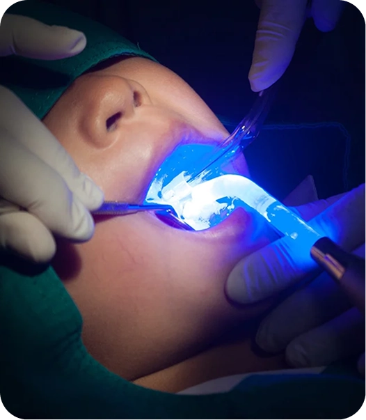 Dental sealant being applied to a tooth to help prevent decay