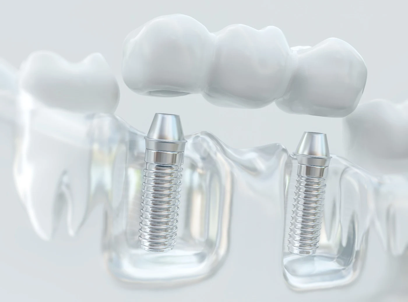 Dental model illustrating tooth replacement with prosthetic crowns