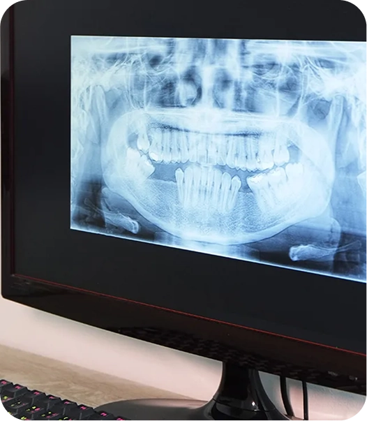 Computer monitor displaying a panoramic digital dental X-ray