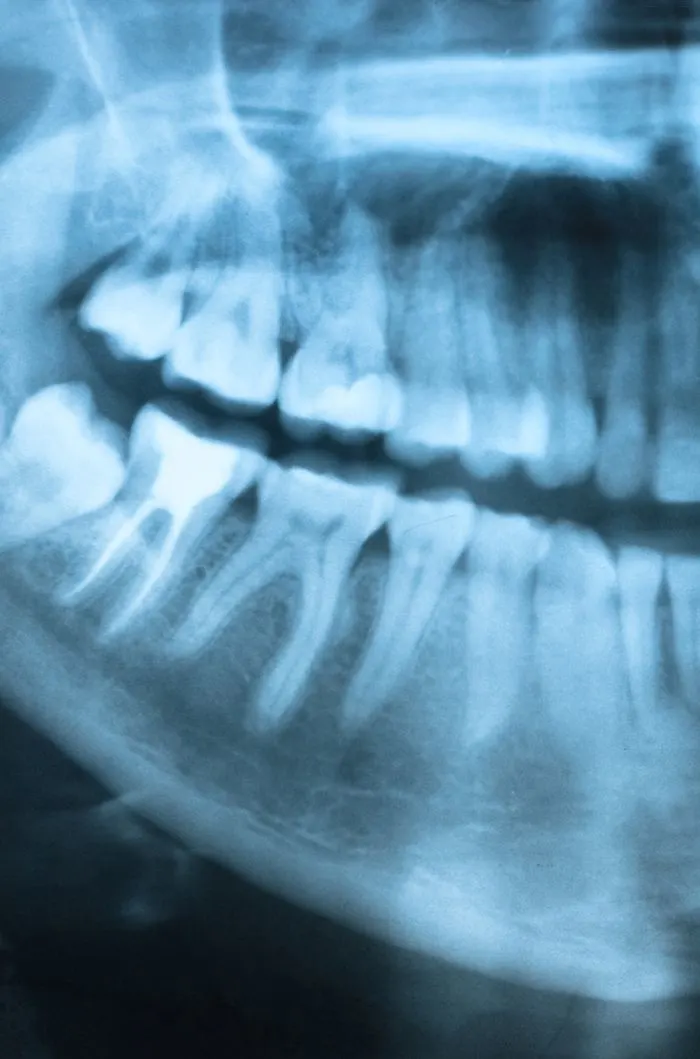 Computer monitor displaying a panoramic digital dental X-ray