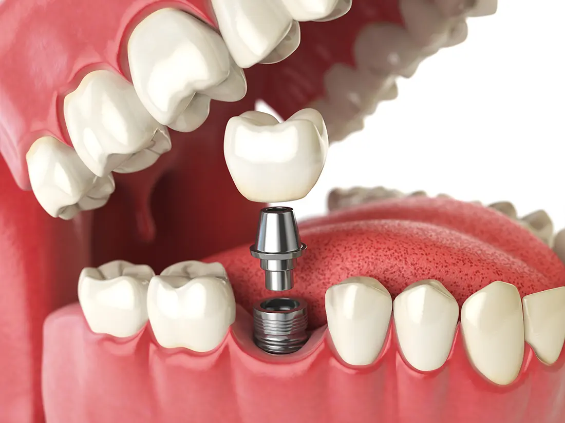 Dental implant crown restoration and clinical care at First Avenue Dental