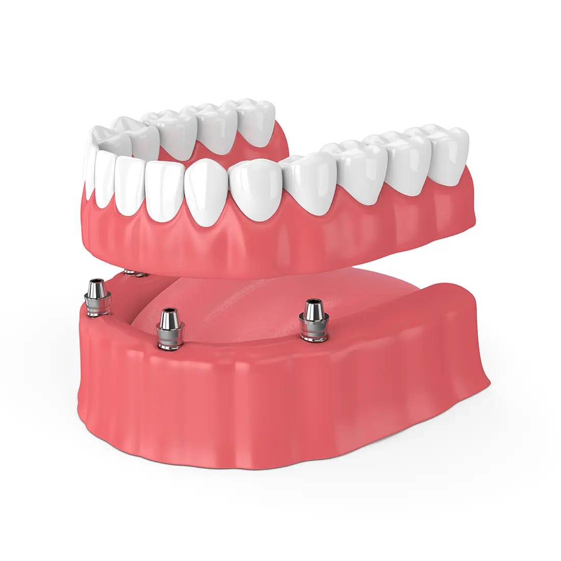 Illustration of implant posts in the lower jaw with a snap-on full denture