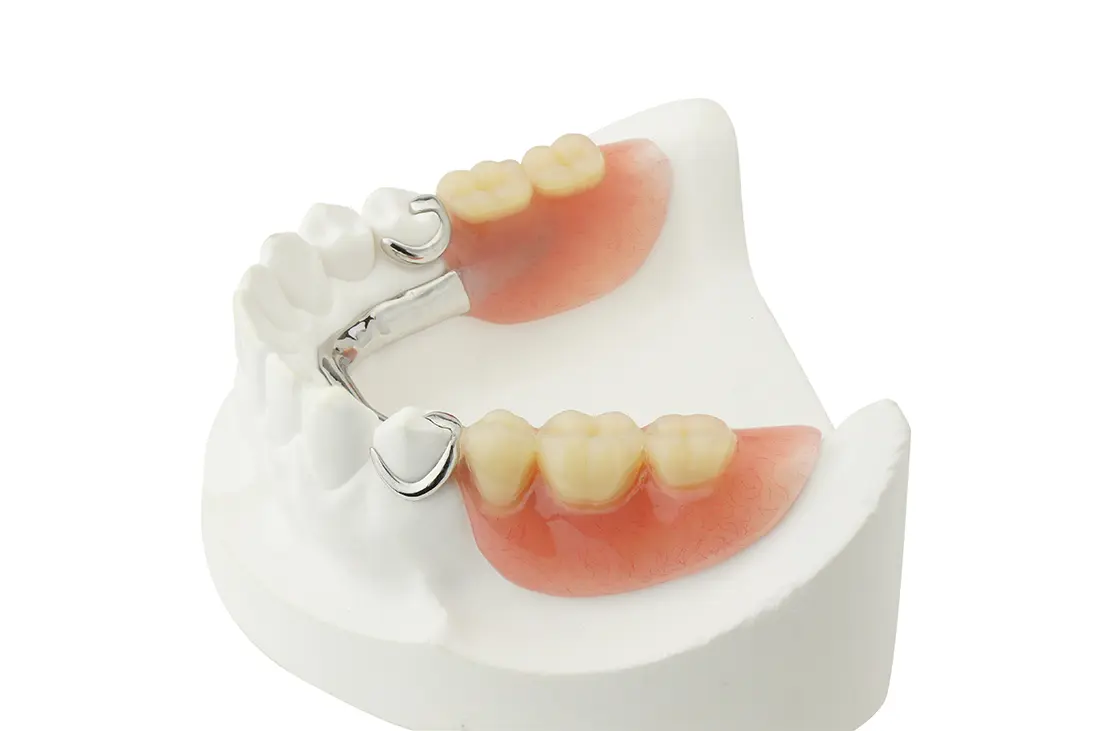 Dental cast of a lower jaw with a removable partial denture and metal framework