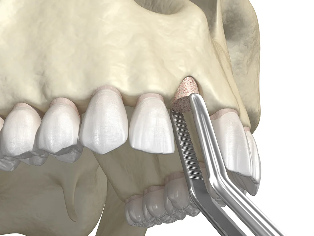 Clinical illustration of jaw and bone-related dental care at First Avenue Dental