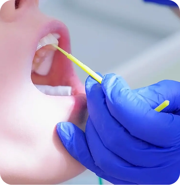 Dental professional applying fluoride treatment to a patient's teeth with a small applicator