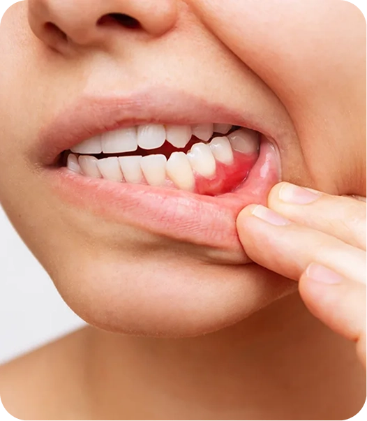 Patient showing lower gums that appear red and inflamed during an oral exam