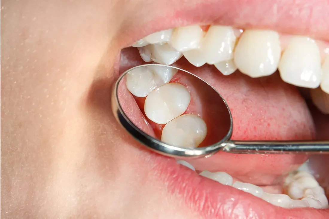 Dentist using a mirror to inspect a tooth with a dental filling