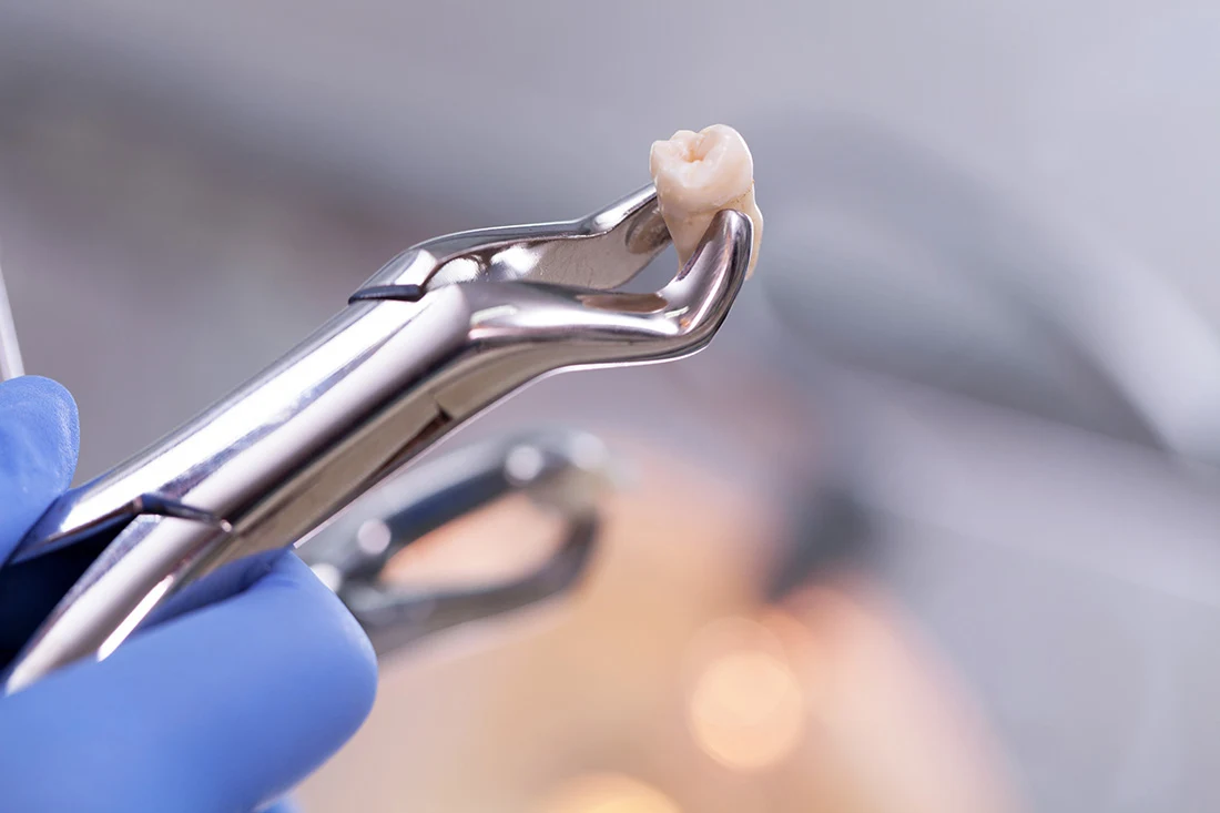 Dental professional performing a careful tooth extraction procedure